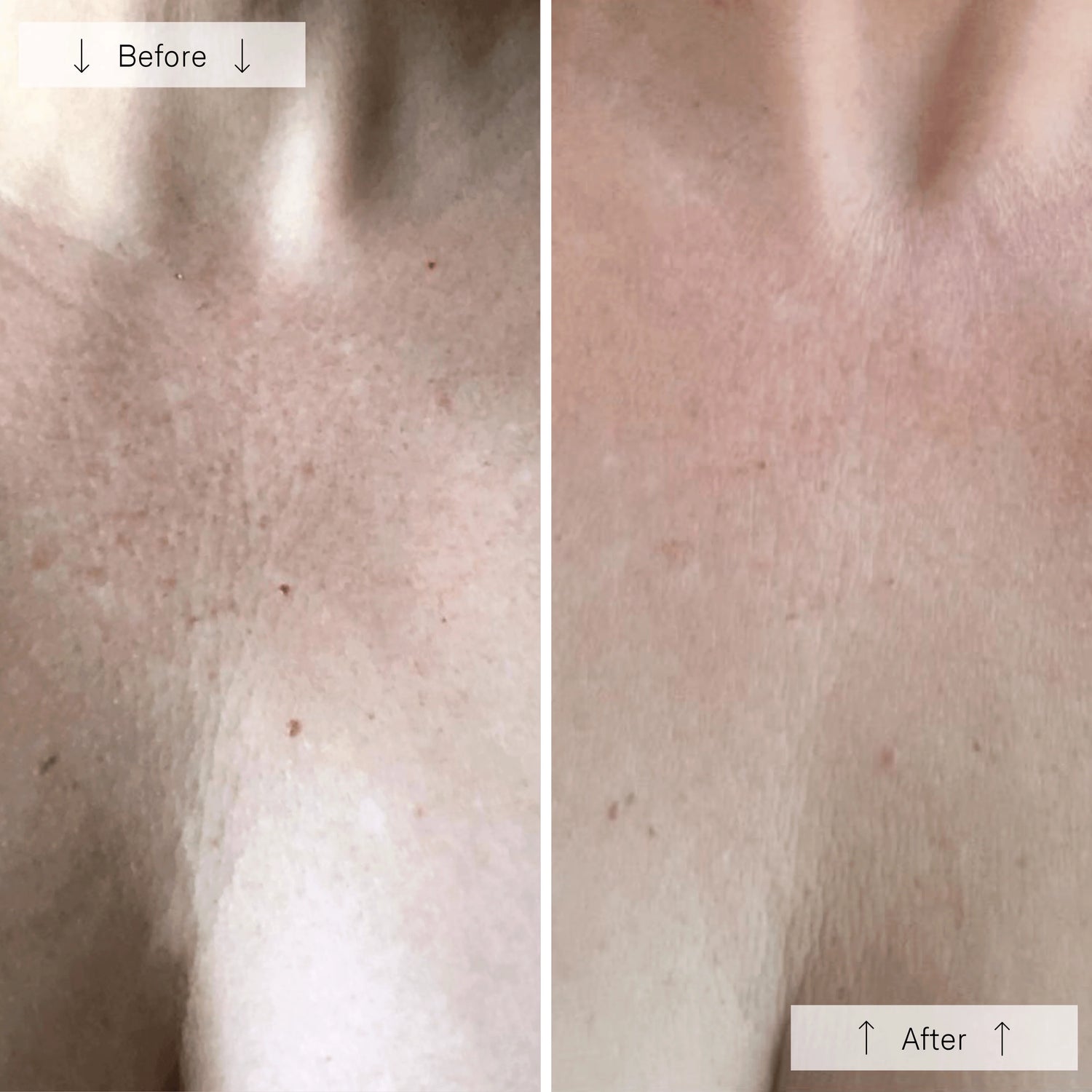 Omnilux Contour Neck &amp; Décolleté